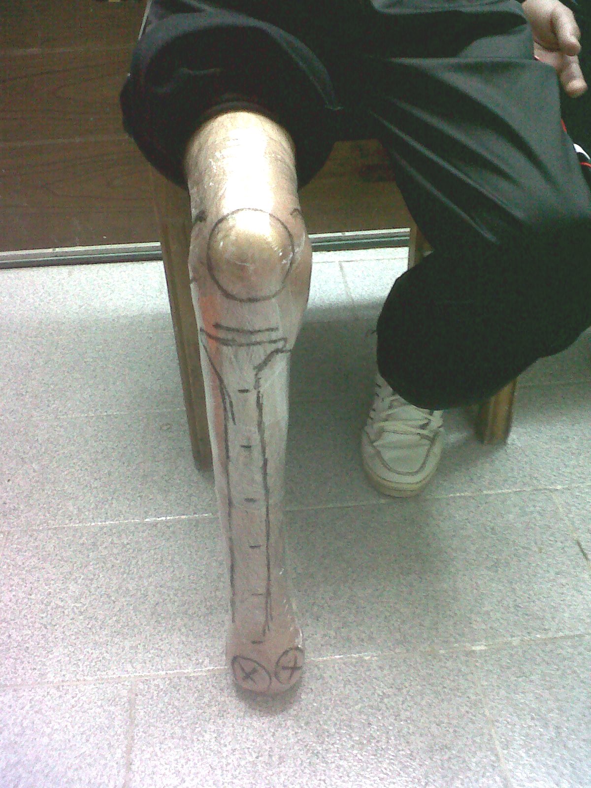 Prótesis Amputaciones parciales de pie