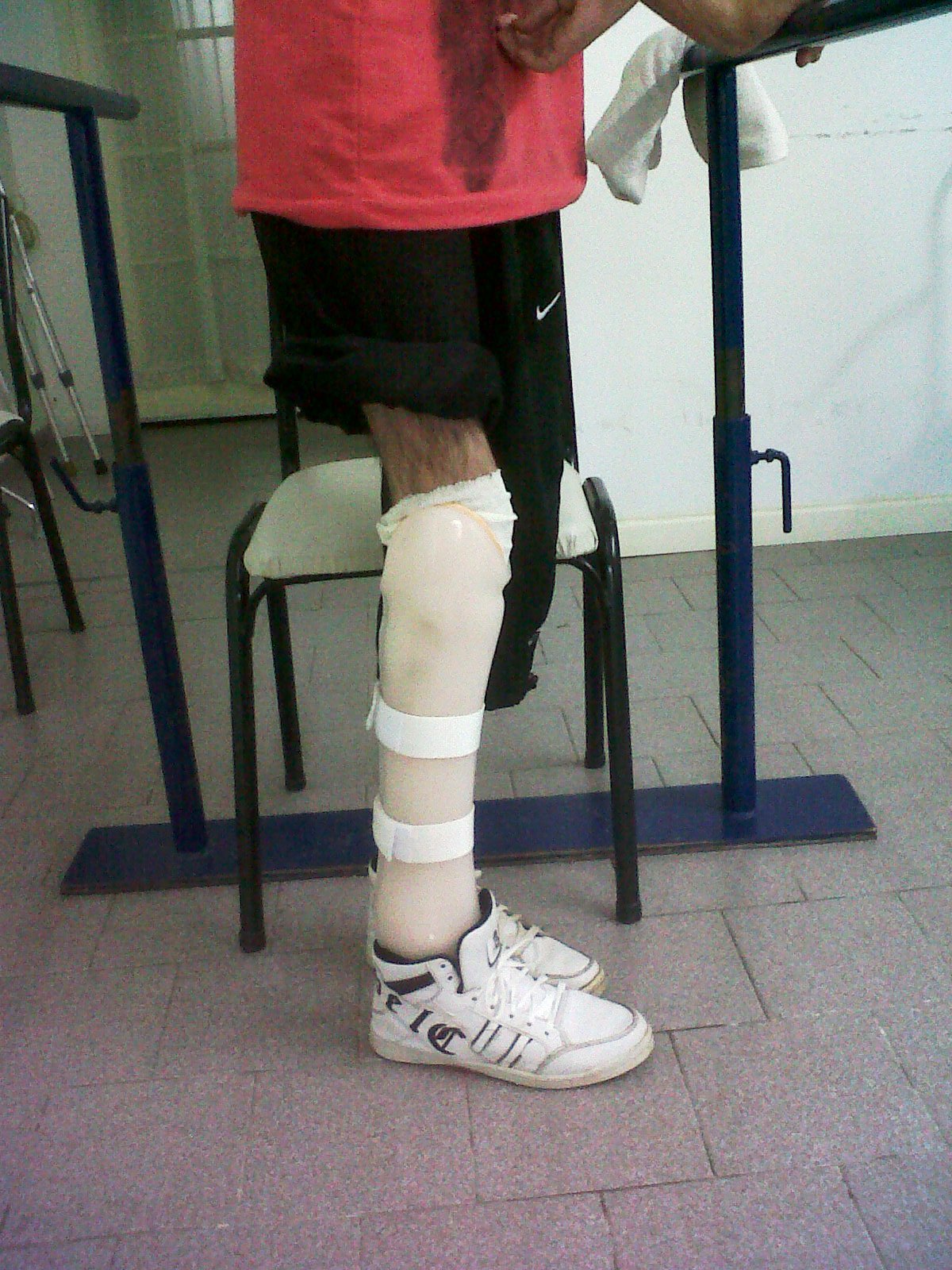 Prótesis Amputaciones parciales de pie