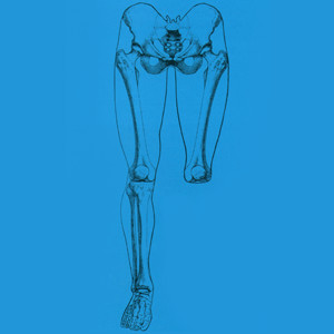 Prótesis Desarticulado de rodilla